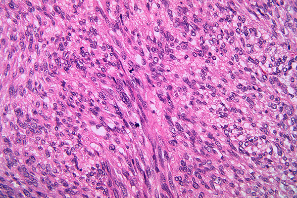 Tumeur stromale gastro-intestinale