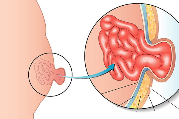 Hernie Ombilicale