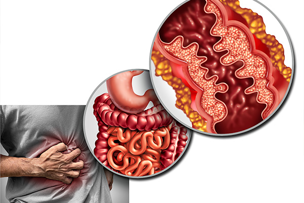 Maladies inflammatoires chroniques de l’intestin