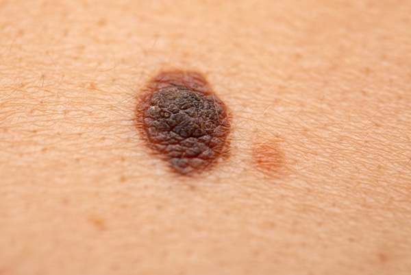 melanomes