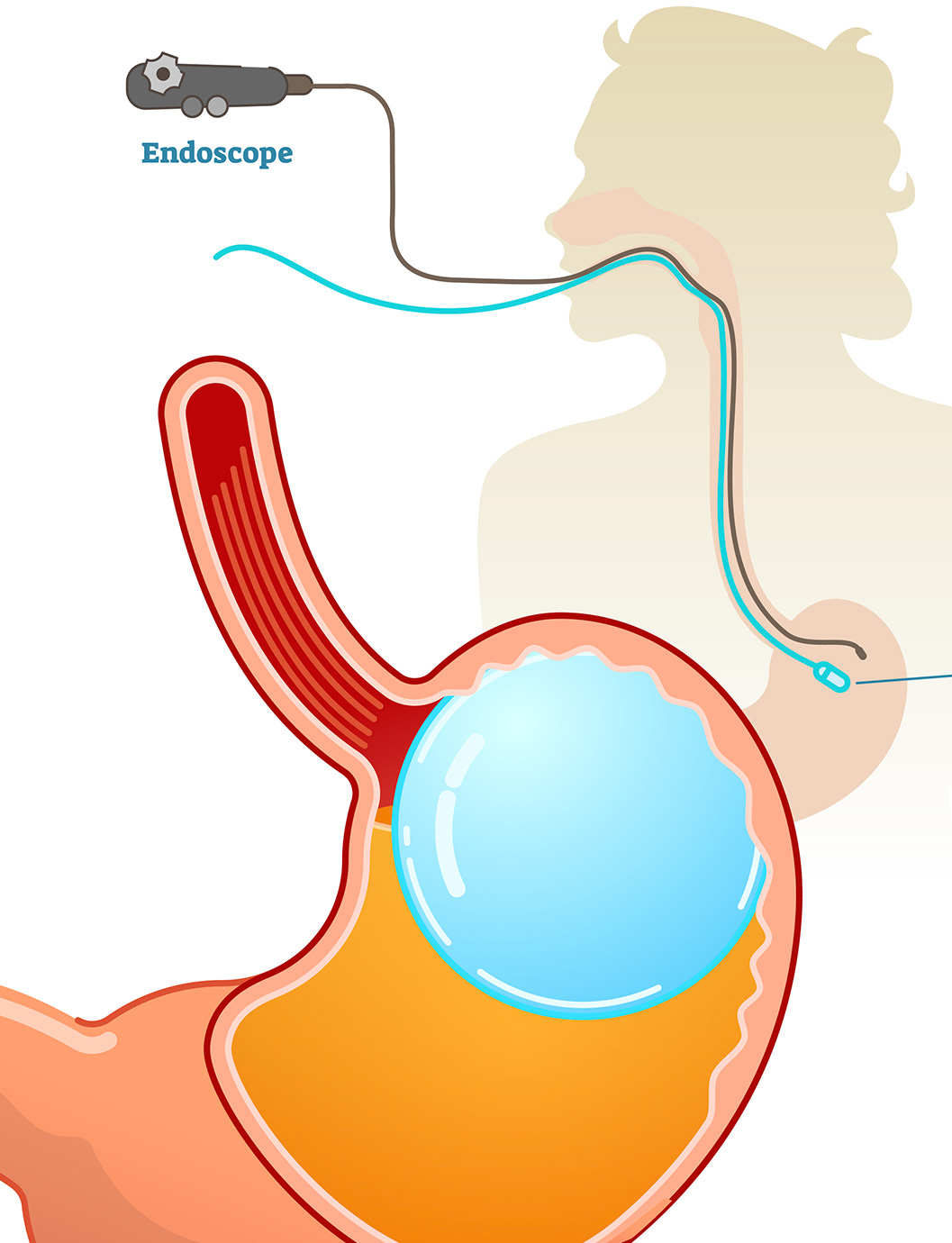 Parcours ballon gastrique