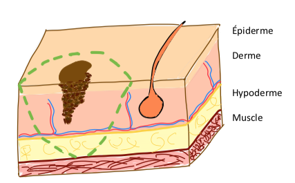 chirurgie melanome