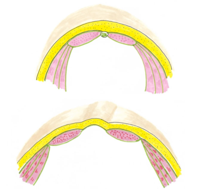 diastasis