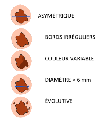 Diagnostic mélanomes