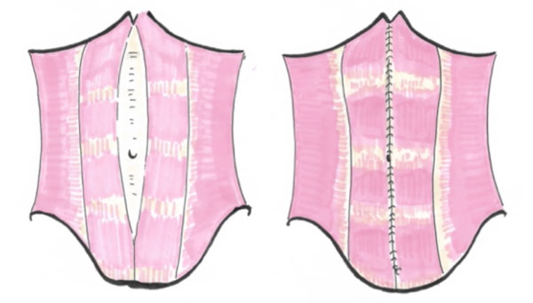 Intervention diastasis