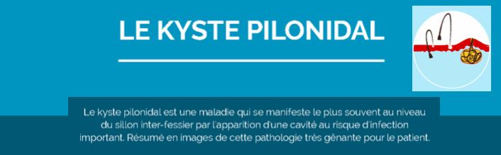 traitement par laser du kyste pilonidal