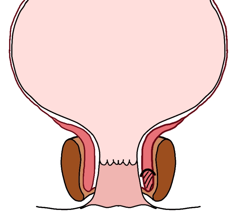 sphinctérotomie latérale interne