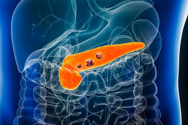 Diagnostiquer une tumeur du pancréas